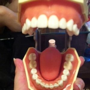 普通と違う歯の模型