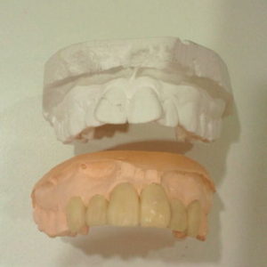 矯正をしないで歯並びを治す方法もあります。