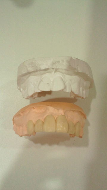 歯列矯正をしないでも歯並びが治ります。