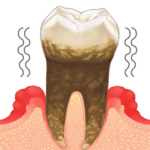 重度歯周病(歯槽膿漏)