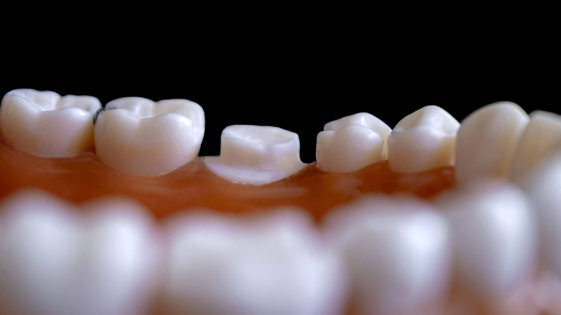 入れ歯・義歯 にお悩みなら東戸塚OCEAN'S DENTAL CLINICへ
