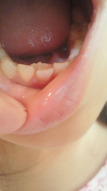 グラグラの乳歯を抜きました。