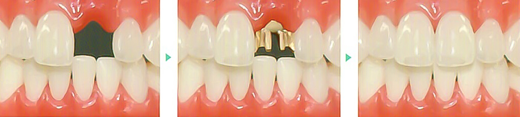 歯を削らない ヒューマンブリッジ について 東戸塚の歯医者ocean S Dental Clinic