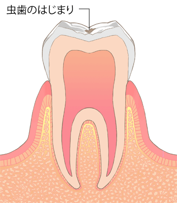 虫歯進行段階C0：なりかけ