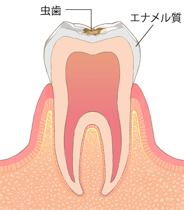 虫歯進行段階C1-エナメル質の初期虫歯