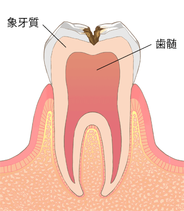 虫歯進行段階C2-象牙質の中期虫歯