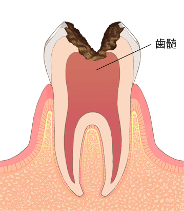 虫歯進行段階C3-神経の重度虫歯