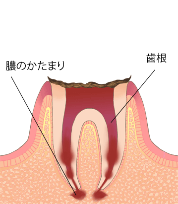 虫歯進行段階C4-歯の根のごく重度な虫歯