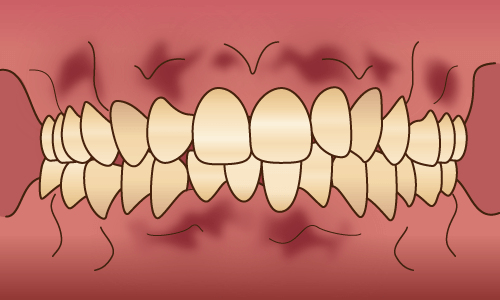 歯茎を健康的なピンク色にする ガムピーリング 東戸塚の歯医者 Ocean S Dental Clinic
