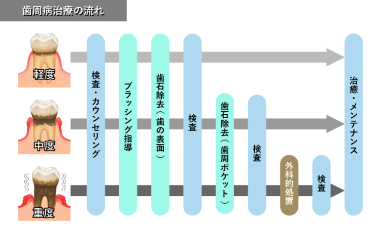 歯周病治療の流れ