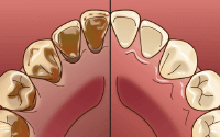 歯のクリーニングと予防歯科