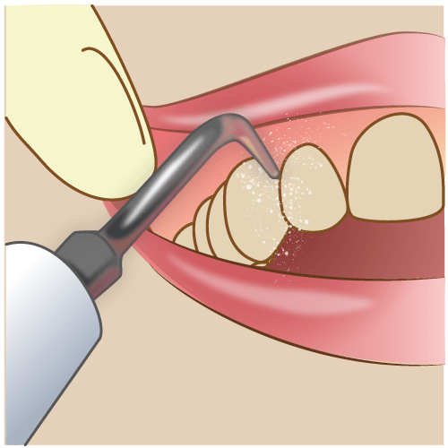 歯周病 歯槽膿漏 の治療と進行セルフチェック 東戸塚の歯医者 Ocean S Dental Clinic